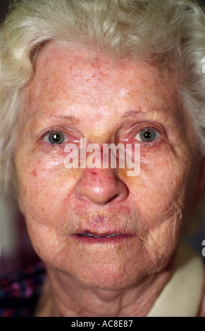 older woman with split lip older woman with bruised face after fall ...