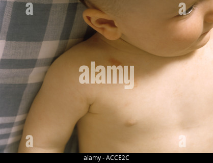 Baby boy with eczema, English, England, British, Britain U.K. UK Stock Photo