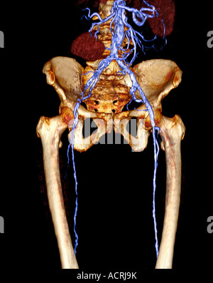 3D CT scan showing 83 year old female with right iliac artery occlusion and severe athersclerotic disease Stock Photo