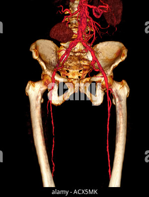 3D CT scan showing 83 year old female with right iliac artery occlusion and severe athersclerotic disease Stock Photo