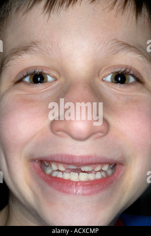 8  year old boy showing his 4 permanent incisors coming in Stock Photo