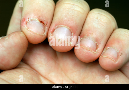 Close up of bitten fingernails Stock Photo