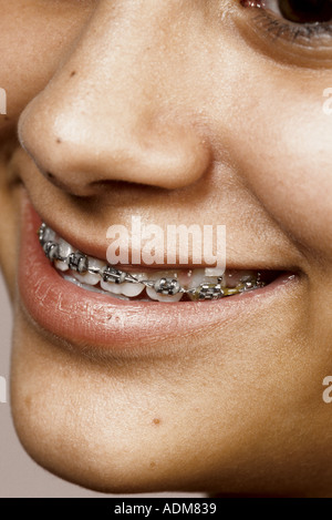 close up of teenage girl in braces Stock Photo