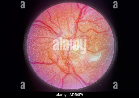 Conceptual view of the Retina and Optic Disc Stock Photo