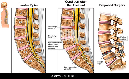 l3 4 and 5 vertebrae