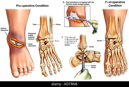 Pre tibial laceration Stock Photo - Alamy