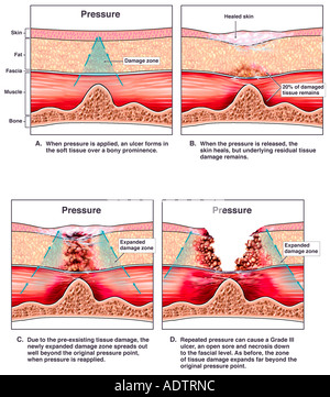 Bedsores ,Decubitus Ulcer ,Pressure Ulcer Stock Photo: 212003452 - Alamy