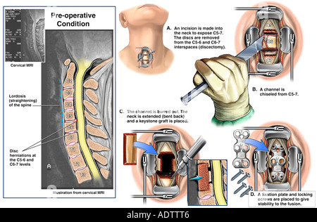 C3 4 C4 5 Cervical Spine Injuries with Surgical Discectomy and Fusion ...