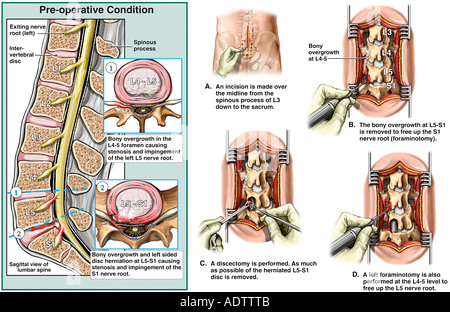 Low Back Injury L5 Lumbar Spine Fracture and ...