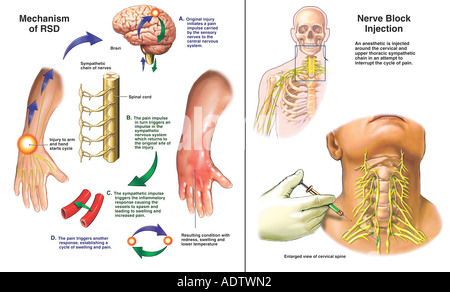 sympathetic reflex dystrophy upper extremity rsd surgical nerve block hand alamy injection traumatic resulting injury leg