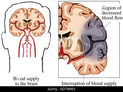 Brain Injury - Hypoxia Ischemia Due to Periventricular Leukomalacia ...