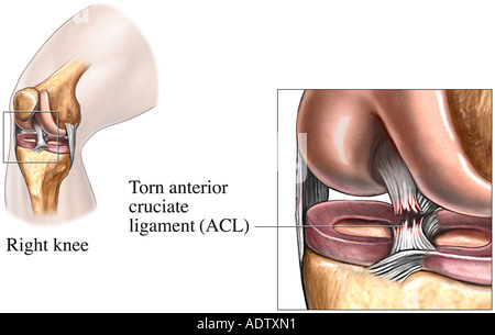 torn acl