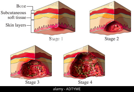 Stages of pressure sores Stock Photo: 49341605 - Alamy