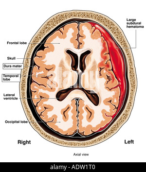 Subdural Hematoma Stock Photo: 134991177 - Alamy