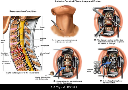 C5-6 Disc Bulge with Surgical Repairs Stock Photo - Alamy