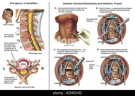 C4-5 and C5-6 Anterior Cervical Discectomy and Fusion Procedure Stock ...