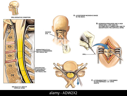 Cervical Spine Injury - C4-5, C5-6 Herniated Discs with Anterior Stock ...