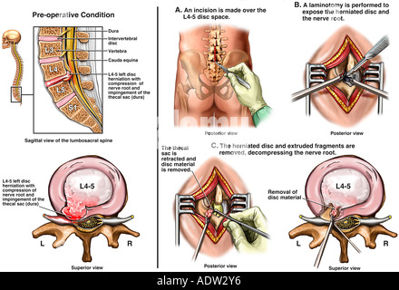 impingement on thecal sac