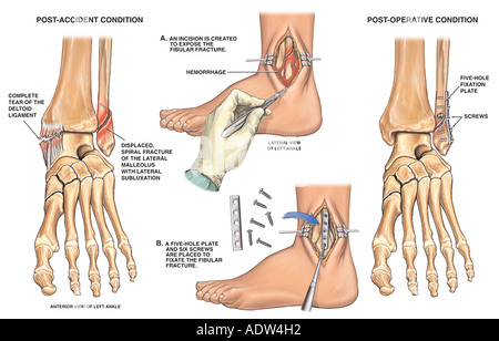 Open reduction and internal fixation of ankle-Ankle operation Stock ...