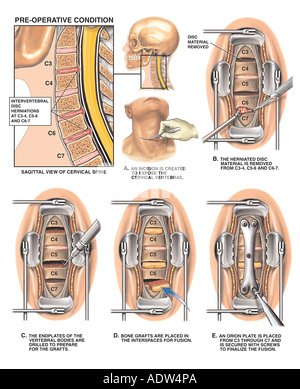 Neck Injuries - C3-4, C4-5 Disc Herniations and C5-7 Osteophytes Stock ...