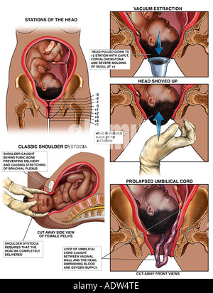 knee chest position for prolapsed cord