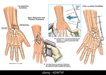 Open Reduction and Internal Fixation (ORIF) of a fracture of the Stock ...