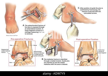 ankle surgery open reduction internal fixation