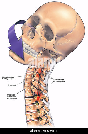 C4-5, C5-6 & C6-7 Bone Fusion Stock Photo, Royalty Free Image: 48642995 ...