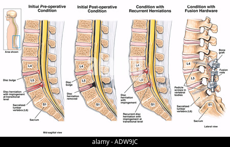 Back Surgery L4 5 and L5 S1 Lumbar Laminotomy and Discectomy Stock ...