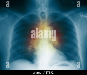 chest xray of a patient with sarcoidosis Stock Photo - Alamy