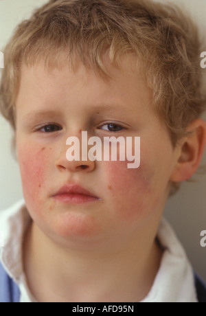 child with a bruised face and black eye Stock Photo