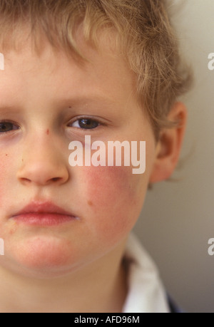 child with a bruised face and black eye Stock Photo