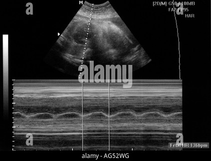 HEART, SONOGRAPHY Stock Photo - Alamy