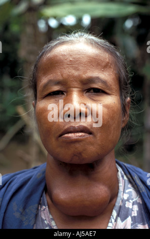 Science Medical Goiter Nodular due to iodine deficiency North Malaya Stock Photo