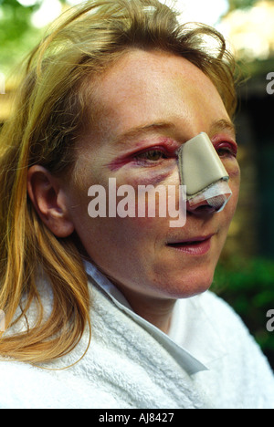 Woman with severe bruising after having had cosmetic surgery to ...