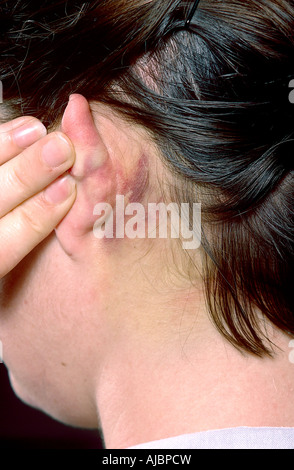 Photograph showing Battles sign also mastoid ecchymosis, an indication of fracture of the base of the posterior portion of skull Stock Photo