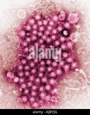 A transmission electron micrograph (TEM) showing numerous hepatitis virions, of an unknown strain. Stock Photo