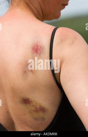 Bruising On Woman's Right Shoulder And Back Stock Photo By, 46% OFF