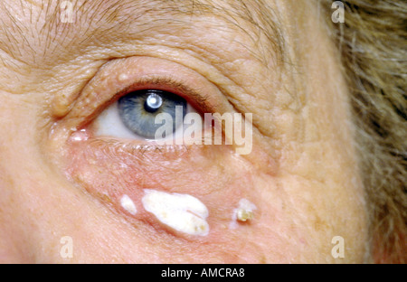 A photograph showing the development of xanthelasma palpebra, a common type of xanthoma Stock Photo
