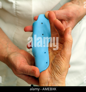 Dupuytrens Contracture Clinical Night Splint Fitting to Fingers and Hand Stock Photo