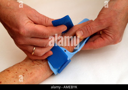 Dupuytrens Contracture Clinical Night Splint Fitting to Fingers and ...