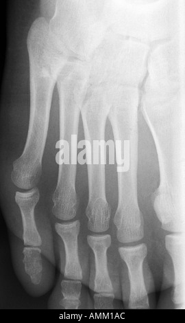 transverse fractures