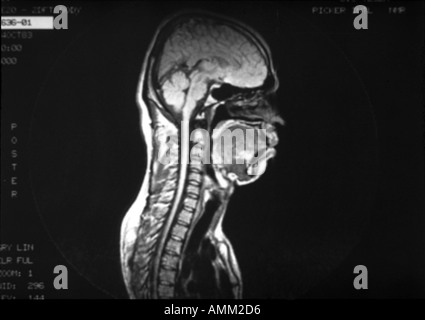 Normal anatomy NMR scan Stock Photo