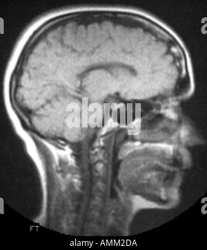 Normal NMR head and neck Stock Photo