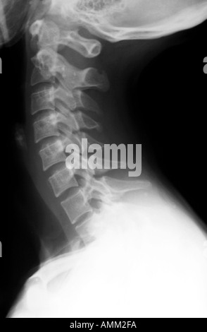 normal cervical spine x rays