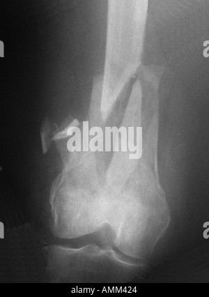 X ray supracondylar fracture of femur Stock Photo