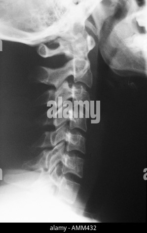 Lateral X-Ray of a cervical spine (neck), showing spasm, but no Stock ...