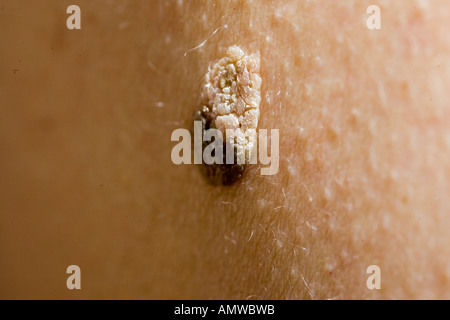 Common wart, verruca senilis Stock Photo