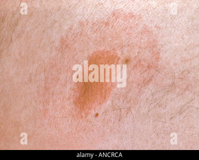 Target Rash from Deer Tick Bite Transmitting Lymes Disease Stock Photo ...