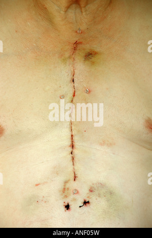 65 year old male chest scar 2 weeks after NHS hospital coronary artery grafting & heart bypass surgery using median sternotomy procedure England UK Stock Photo